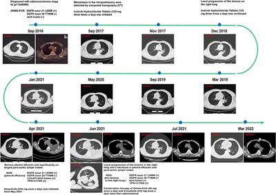 Case Report: Heterogeneity of Resistance Mechanisms in Different Lesions Co-Mediate Acquired Resistance to First-Line Icotinib in EGFR Mutant Non-Small Cell Lung Cancer